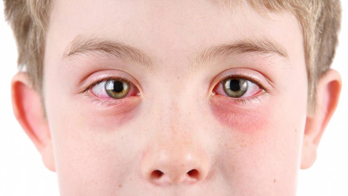 Allergic conjunctivitis treatment for good vision