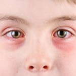 Allergic conjunctivitis treatment for good vision