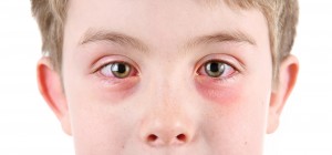 conjunctivitis treatment