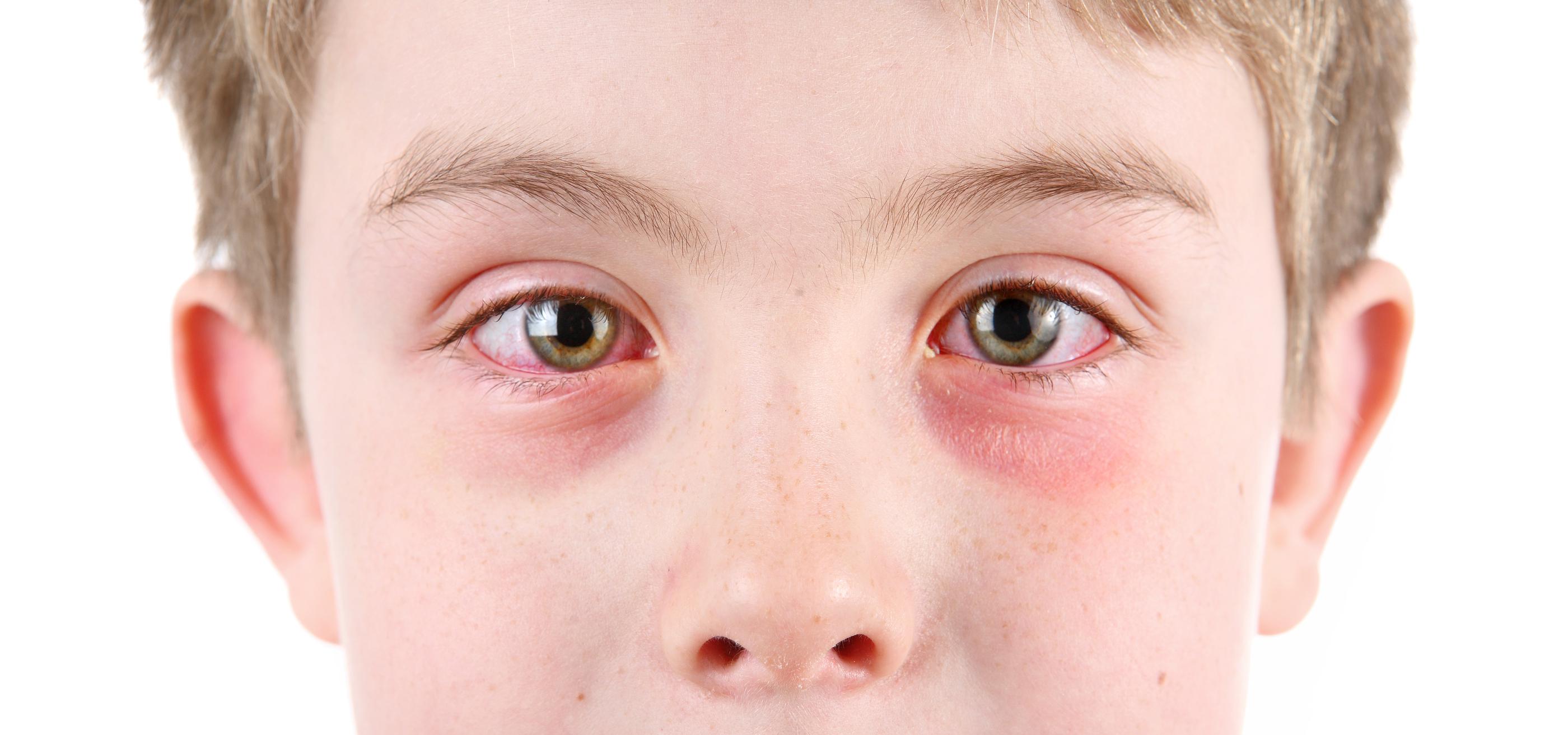 What causes rashes to form around one eye but not the ...