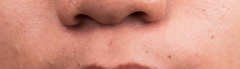 Home remedies for blackheads