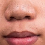 Home remedies for blackheads