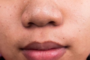 Home remedies for blackheads