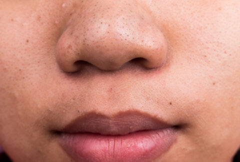Home remedies for blackheads