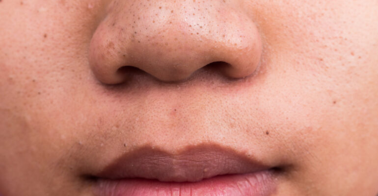Home remedies for blackheads