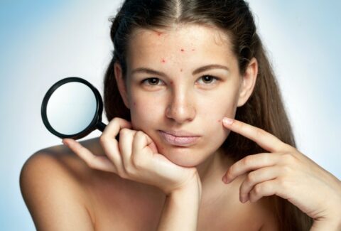 Home remedies for whiteheads