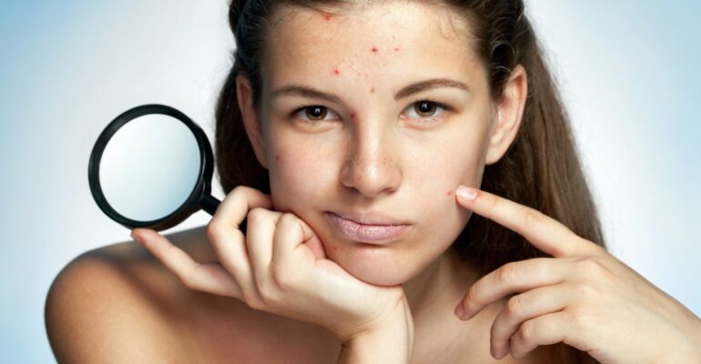 Home remedies for whiteheads