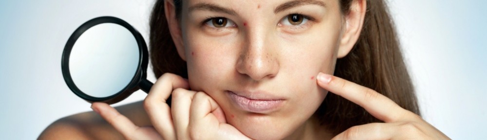 Home remedies for whiteheads