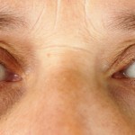 Remove dark circles under eyes