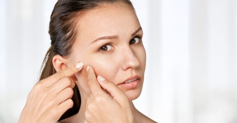 food that prevents acne