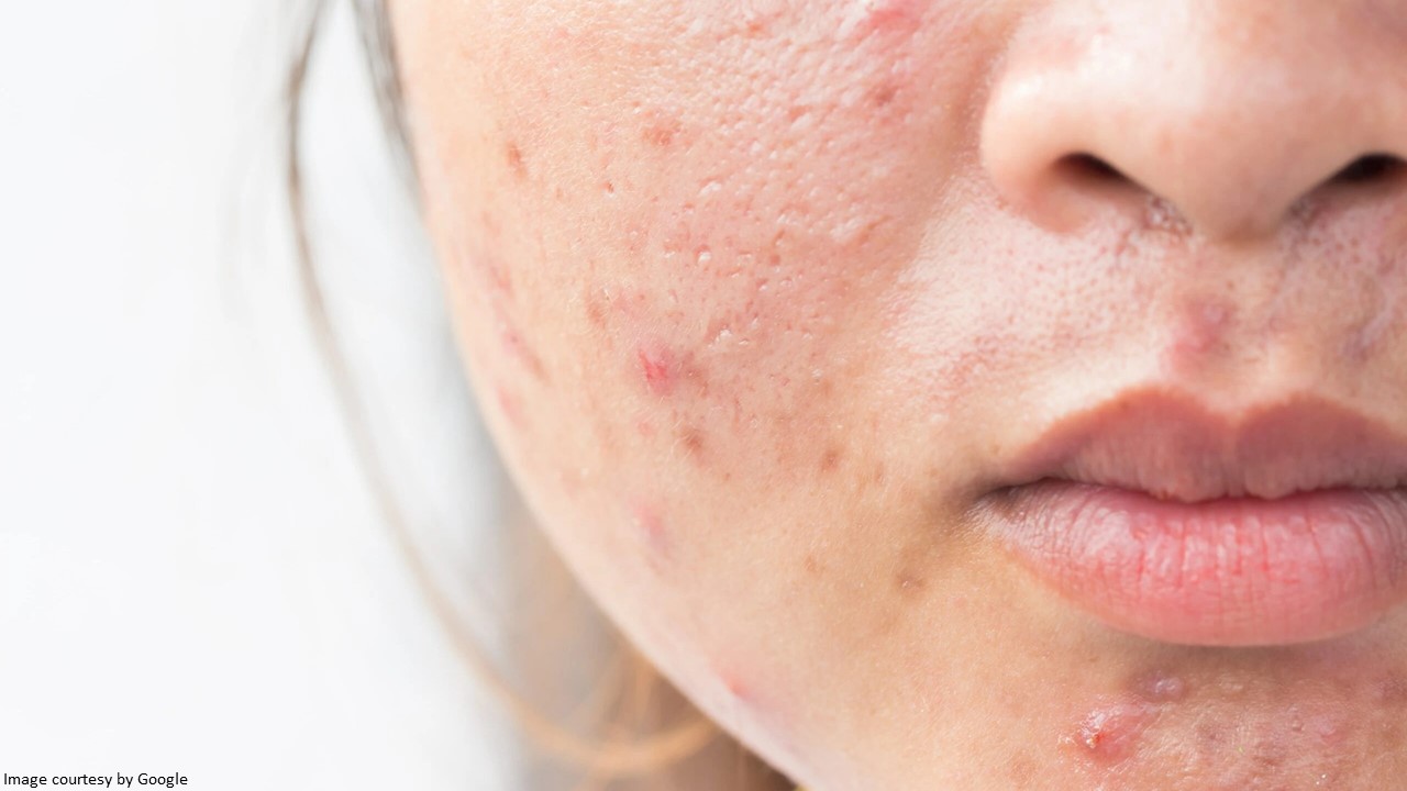 Best treatment for scars on face - All Day Chemist