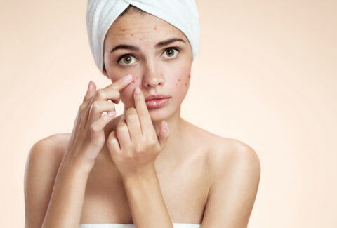acne scars