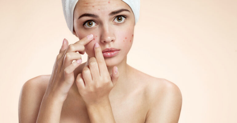 acne scars