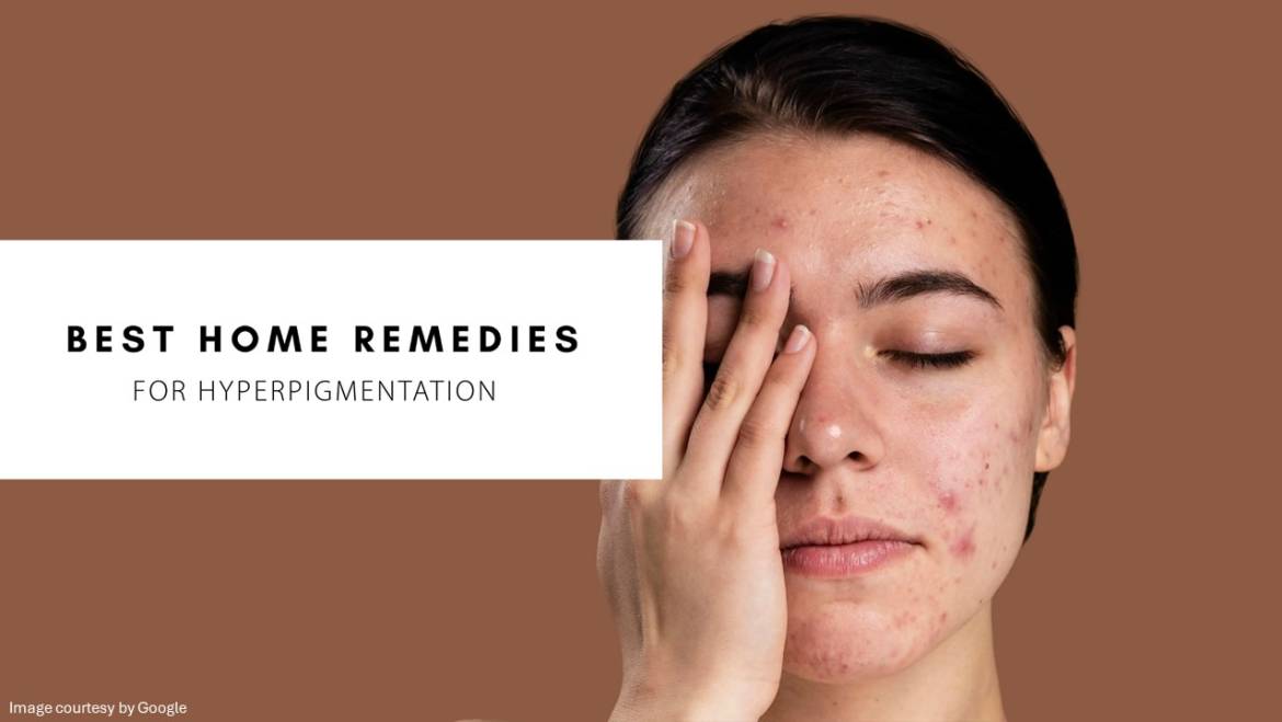 Home remedies for pigmentation