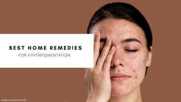 Home remedies for pigmentation