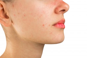 Home remedies for whiteheads