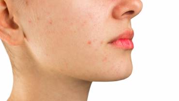 Home remedies for whiteheads