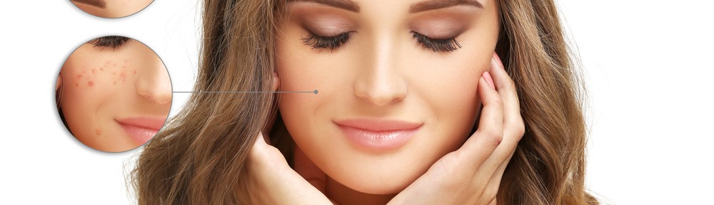 Home remedies for whiteheads