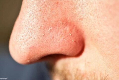 A person demonstrating effective skincare, using home remedies to remove whiteheads.