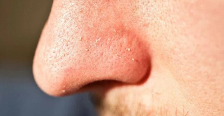 A person demonstrating effective skincare, using home remedies to remove whiteheads.