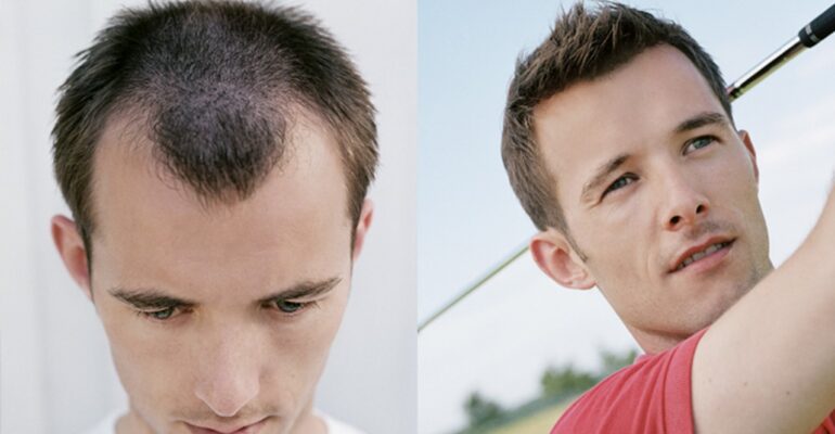 home remedies for baldness - All Day Chemist