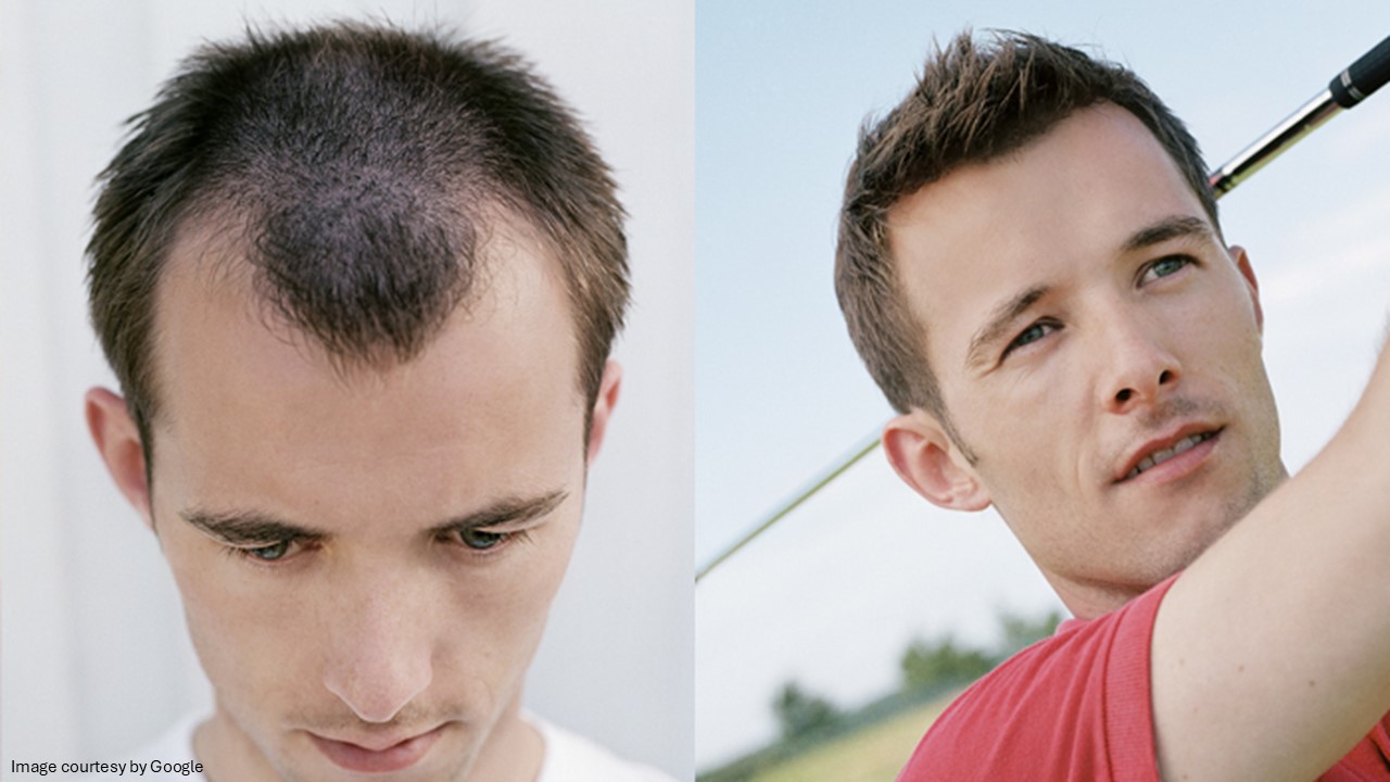 home remedies for baldness - All Day Chemist