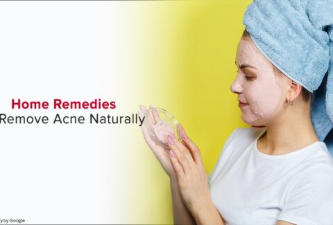 home remedies for acne