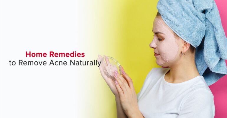 home remedies for acne