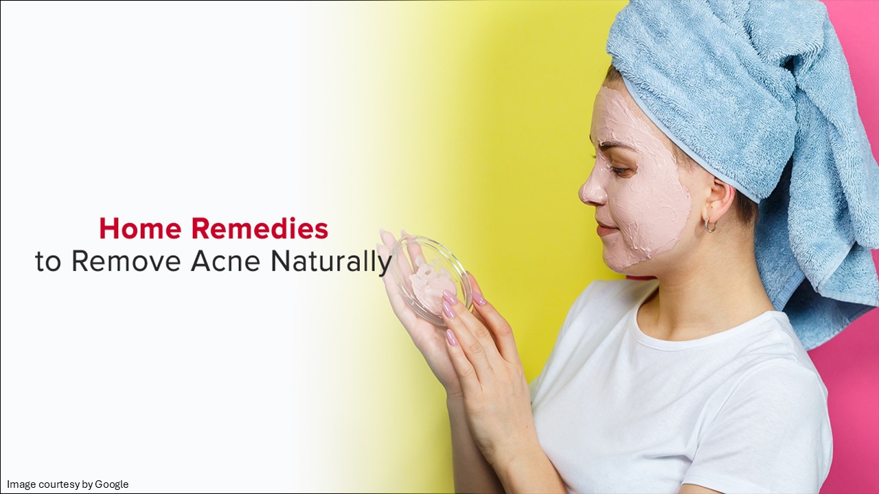 home remedies for acne