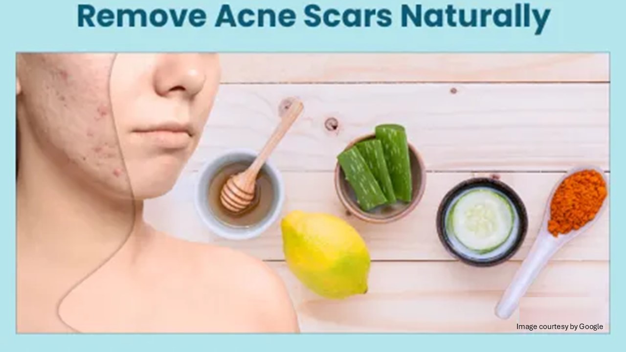 home remedies to acne​