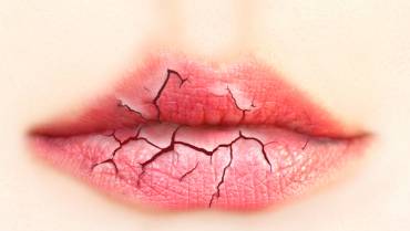 Home remedies for chapped lips
