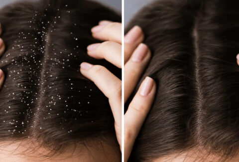 Hair care tips for managing dandruff and dry scalp