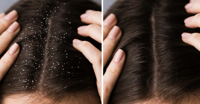 Hair care tips for managing dandruff and dry scalp