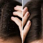 Dandruff And Dry Scalp Are Different But Need Similar Treatment