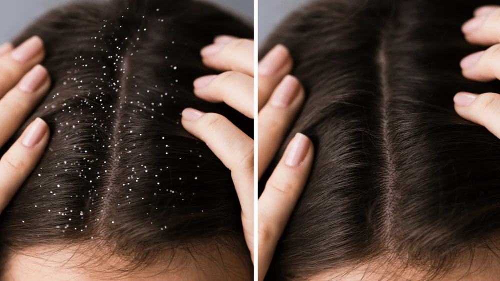 Dandruff And Dry Scalp Are Different But Need Similar Treatment