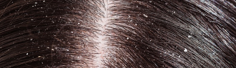 Dandruff and dry scalp are different, but need similar treatment