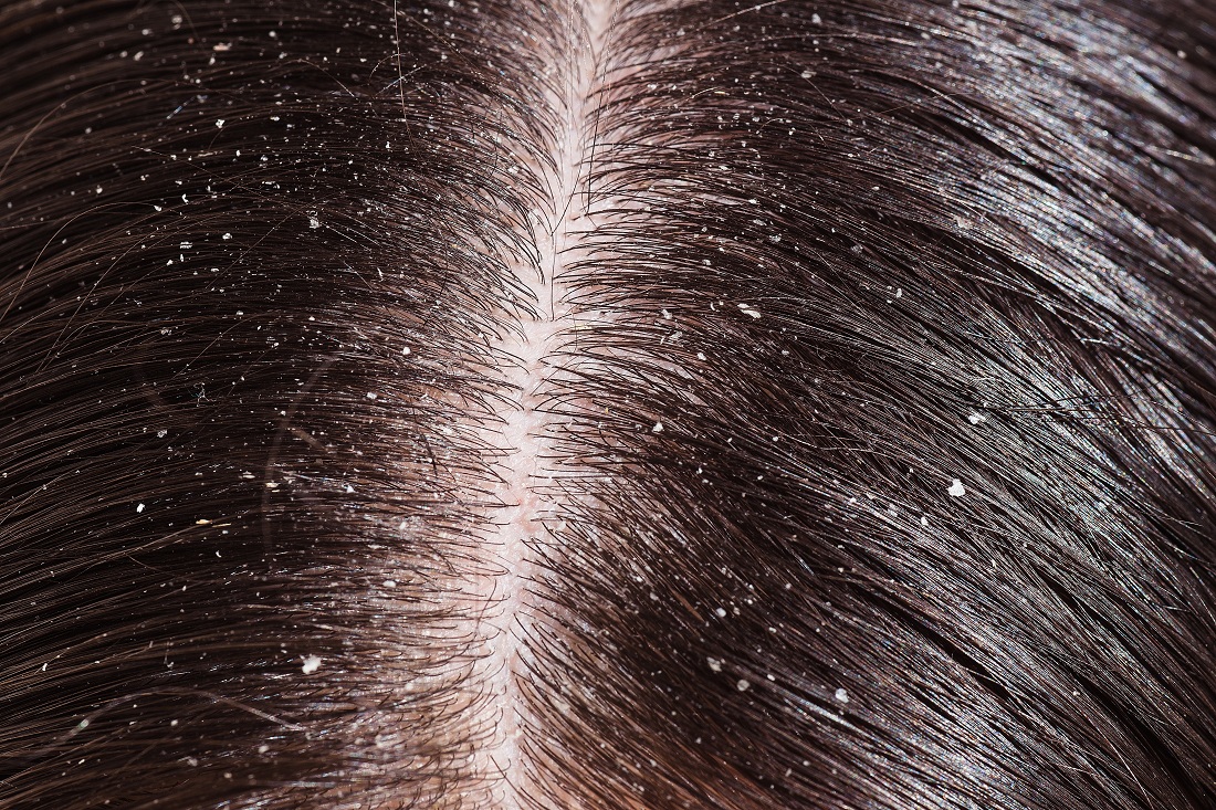 Dandruff and dry scalp are different, but need similar treatment