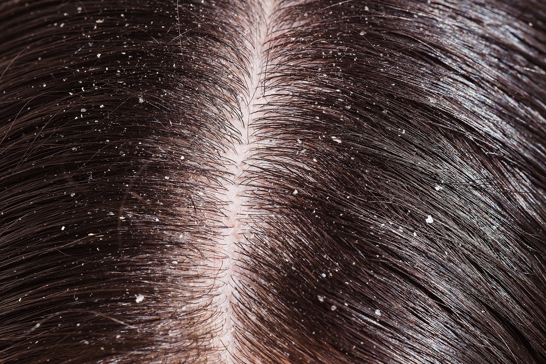 Dandruff Picture Image on MedicineNet.com