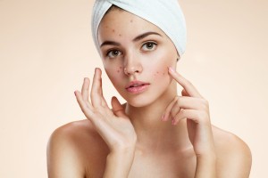 acne myths