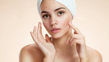 Stay clear about acne myths and facts