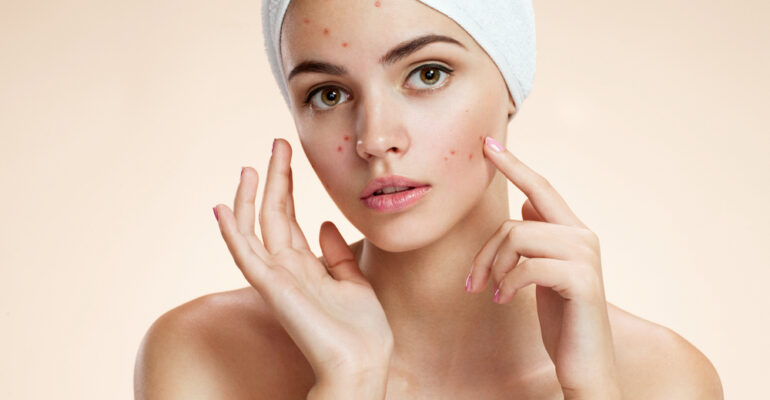 acne myths