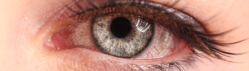 remedies for pink eye