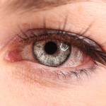 Understand effectiveness of home remedies for pink eye