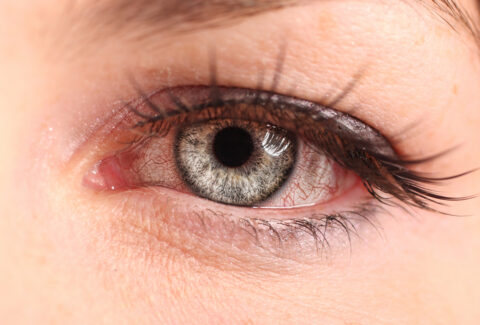 remedies for pink eye