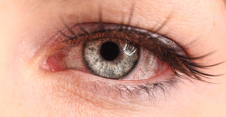 remedies for pink eye