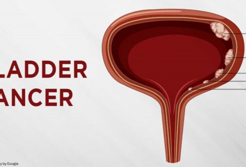 Bladder cancer treatment - ADC