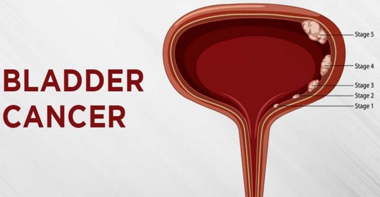 Bladder cancer treatment - ADC