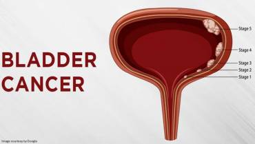 Bladder Cancer Causes, Symptoms and Treatment