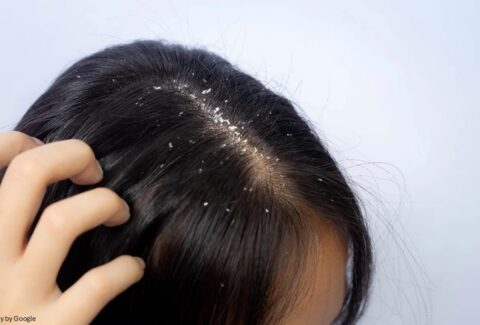 dandruff treatment - All Day Chemist