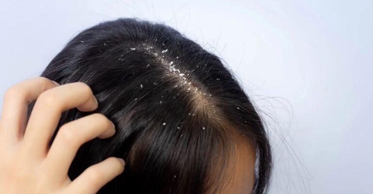 dandruff treatment - All Day Chemist
